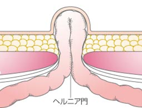 でべそ（臍ヘルニア）とは？