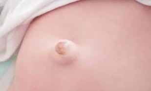 赤ちゃんのでべそ（臍突出症・臍ヘルニア）について