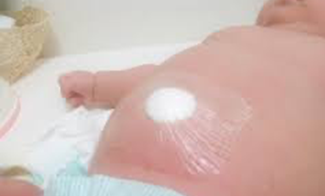 圧迫療法の具体的な手順、通院の頻度、治療期間